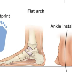 Custom Made Insole Flat-Feet