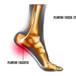 Plantar Fasciitis Custom Made Insole