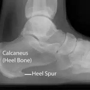 Bone Spur & Plantar Fasciitis