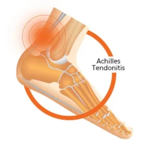 Achilles Tendon Support Insole 2