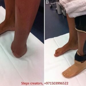 Partial Foot Prosthesis