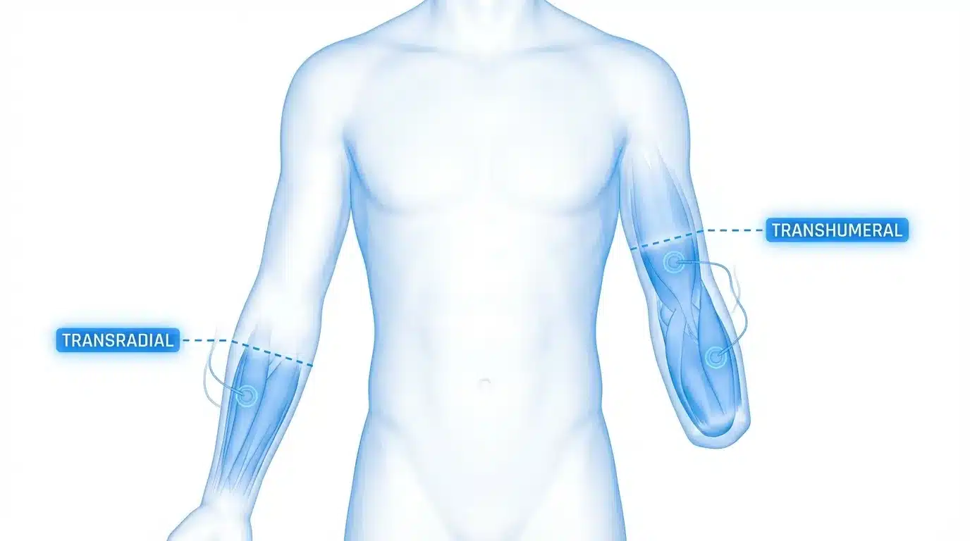 Upper limb amputation types — below elbow and above elbow amputee daily challenges